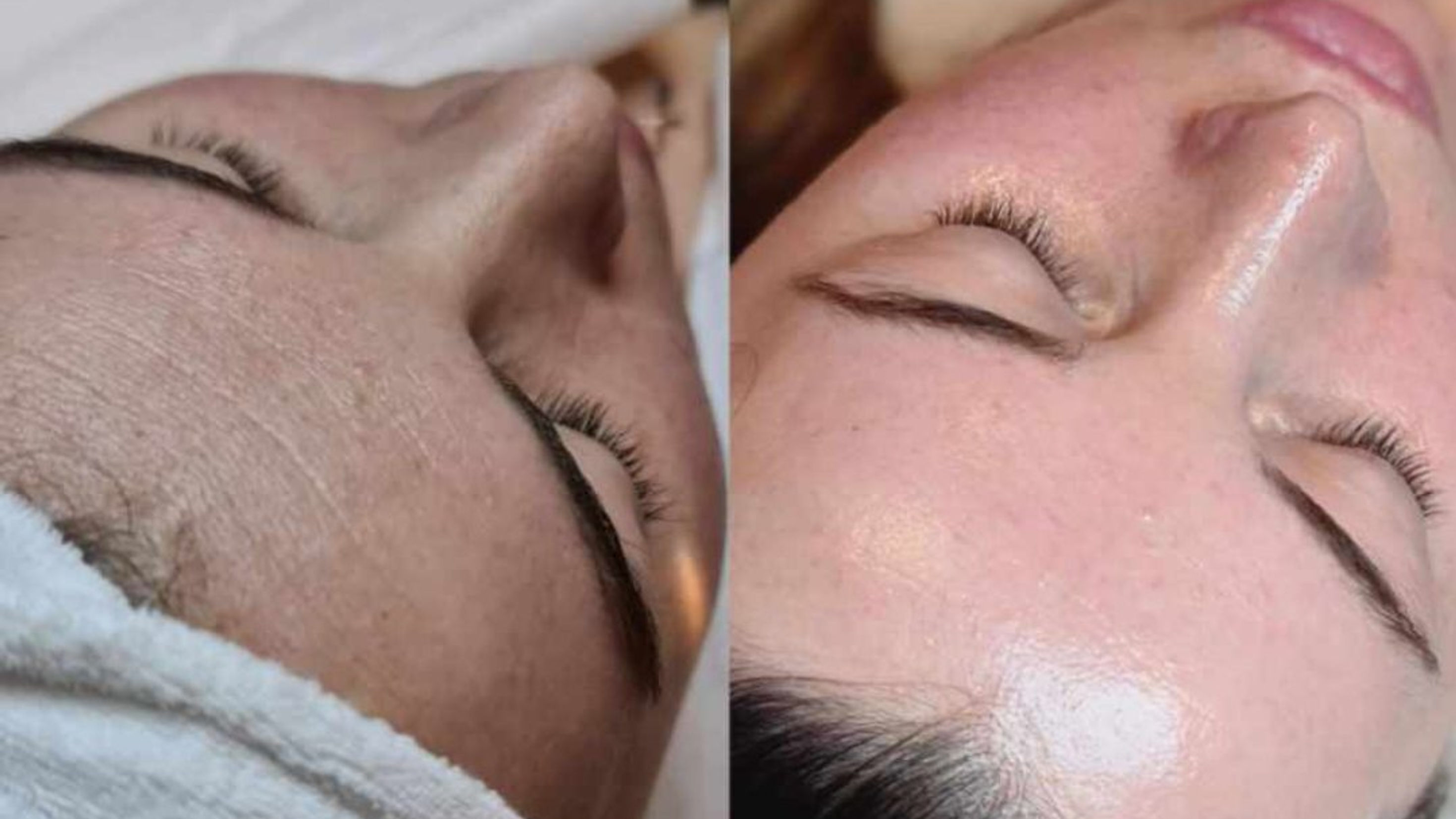 LK DermaBeauty HydraFacial